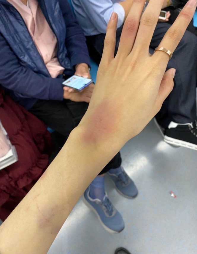 The hand of the girl claiming to be Huanfeng's ex while accusing him of abuse.